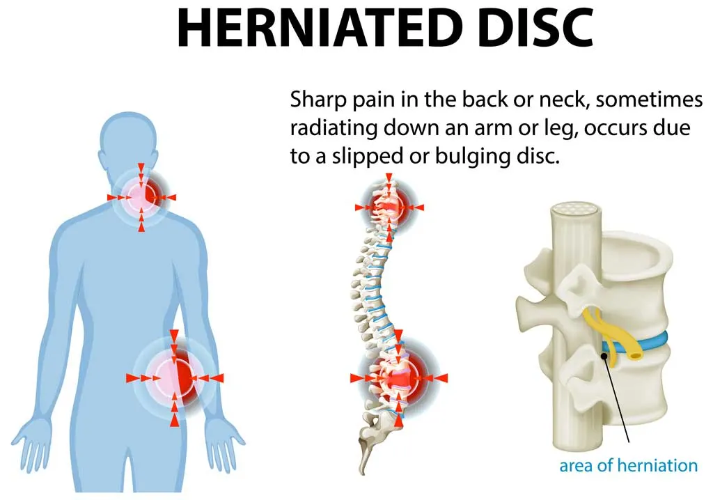 Fascial Manipulation for DDD