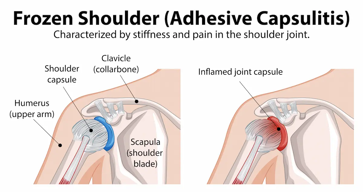 Frozen shoulder Adhesive capsulitis