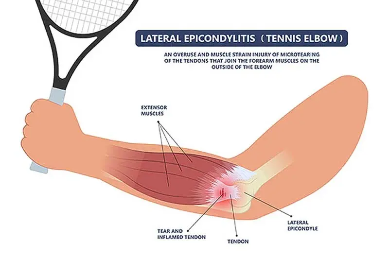 tennis elbow Lateral epicondylitis